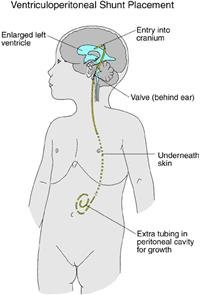 Brain tumors