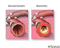 Bronchitis
