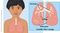 Pneumonia In Children