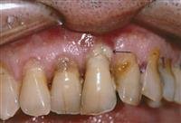 Enteritis in children....