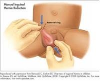 Inguinal Hernia