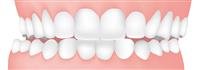 Reverse bite: what it is and how to cure it