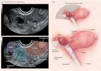 What to Know About  Ectopic  Pregnancy
