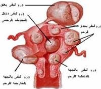الورم الليفي في الرحم