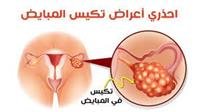 تكيس المبايض: الأعراض والعلاج.