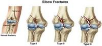 Broken Elbow