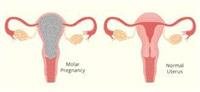molar pregnancy.
