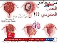 الحمل العنقودي .