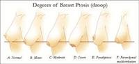 Breast Lift