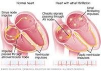 What Are the Symptoms of Atrial Fibrillation?