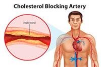 Spot Heart Attack, Stroke, and Angina Symptoms