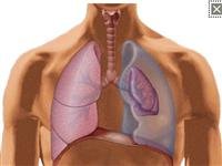 Pneumothorax