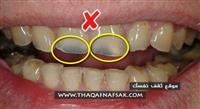 Strengthening teeth in 31 ways makes them durable