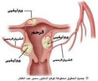 الأورام الليفية