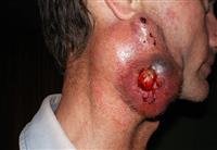 Neck Cancer