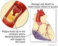 Heart Attack Causes and Treatments