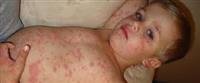 Measles - Important