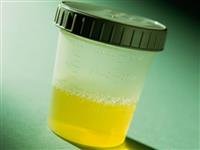 Antibiotic Resistance Common in Kids' Urinary