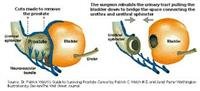 Radical Prostatectomy