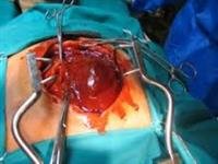 Open Heart Surgery