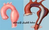 Clogged arteries