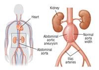 Aortic Aneurysm Symptoms, Causes, and Treatment