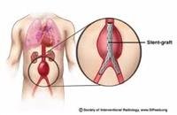 How Is an Aneurysm Treated?