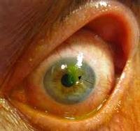 Corneal Abrasions