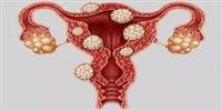 What is endometriosis disease?