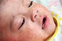Measle s