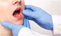 Oral cancer: symptoms, causes, treatment and more