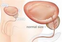Prostate Problems