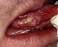 oral  Cance