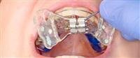 maxillary narrowness
