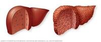 Fatty  Liver  Disease