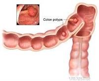 Colon Cancer Treatment