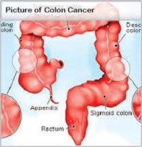 Rectal & Colon Cancer in Men