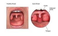 Why Do I Have a Sore Throat?
