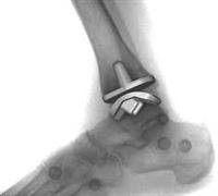 Is Ankle Replacement Right for You?