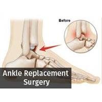 What You Need to Know About Ankle Replacement