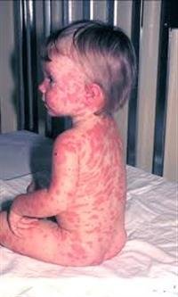 Side Effects of the Smallpox Vaccine