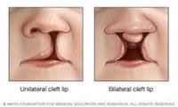 Cleft Lip and Cleft Palate