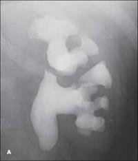 Methods of treating urinary stones