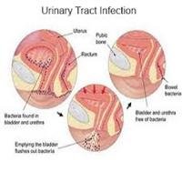 Urinary tract infection (UTI)