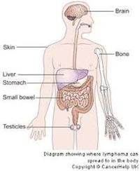 Understanding Non-Hodgkin Lymphoma