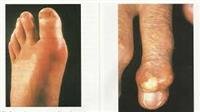 Acupuncture   for Arthritis