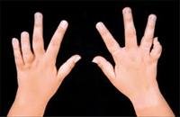 Arthritis, Juvenile Rheumatoid