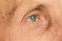 What Is Rheumatoid Arthritis?