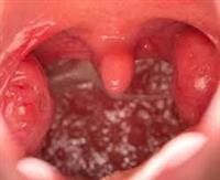 Tonsillitis: Causes, symptoms, and treatment