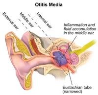 What is Otitis Media?